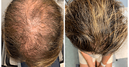 DYNAMIC AESTHETIC CLINIC IN DUBAI : Can I Take Finasteride for Hair Loss?