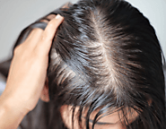 Does Finasteride Stop DHT? – skincareae