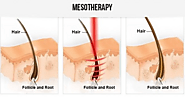 Can you Mix PRP with Mesotherapy? | DYNAMIC AESTHETIC CLINIC IN DUBAI - 楽天ブログ