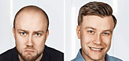 The Science Behind Successful Hair Transplants in Dubai – Tivixy