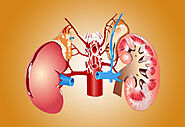 Nephrotic Syndrome in Ayurveda - Ayurvedic Kidney Care