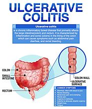 Colitis Treatment in Indore, Best Colitis Treatment in Indore | Intimate Clinic