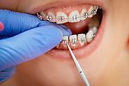 How to Handle a Broken Bracket on Your Braces | Step-by-Step Guide