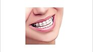 Esthetica Dental: Top Teeth Whitening Treatment in Mohali, Bright Smiles!