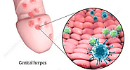 Genital herpes penis | Symptoms, Causes and Treatment