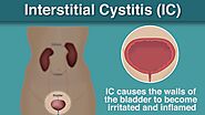 Treatment for Interstitial Cystitis - Philadelphia Holistic Clinic - Dr. Tsan