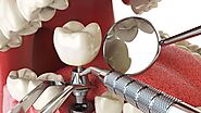 Exploring the Use of Anesthesia During Dental Implant Surgery