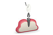 Experience Life-Changing Advantages with Robust Dental Implants