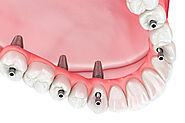 Unveiling the Consequences of Ignoring Dental Implants