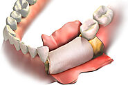 Your Guide to Dental Implants After a Bone Graft Procedure