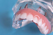 Transform Your Smile with Full Mouth Dental Implants in Gilbert, AZ