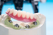 Get a Stable and Comfortable Smile with Implant-Supported Dentures