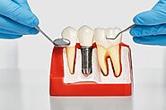 Phoenix Implant Dentists: Expert Care for a Stunning Smile