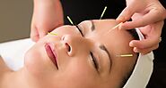 Acupuncture in Bromley: Your Gateway to Pain Relief and Relaxation with London Osteopathy and Pilates - Elissa Bell's...