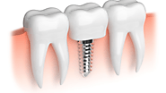 A Comprehensive Guide to Dental Implant Surgery Recovery