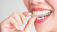 Adults Should Know 5 Things Before Choosing an Invisalign Provider