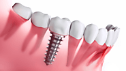 The Complete Breakdown of Dental Implant Costs for a Single Tooth
