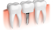 Understanding Dental Implants for Young Adults