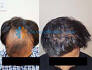 Successful Hair Transplant at Cosmed Clinic, Mira Road, Thane, Mumbai.