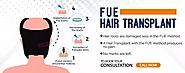 FUE hair transplant in Mumbai | FUE hair transplant cost in Mumbai