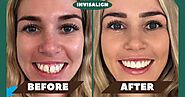 Invisalign Before and After Overbite or Open Bite Including 5 Things About Overbite That You Should Know - Morgan Hil...