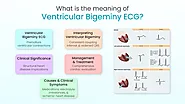 What is the meaning of Ventricular Bigeminy ECG?