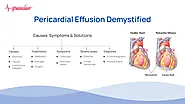 Pericardial Effusion Demystified: Causes, Symptoms, and Solutions