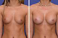Implants mammaires - poitrine- seins: Info & Prix