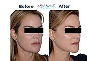 #1 Best V-Shape Face lifting Treatment in Durgapur