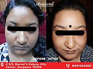 #1 Best Skin Rejuvenation Treatment in Durgapur