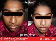 #1 Best Skin Whitening Treatment In Durgapur