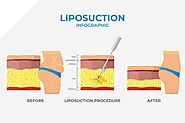 Best Ultrasonic Liposuction Treatment in Durgapur