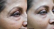 Fine Lines and Wrinkles Removal Treatment