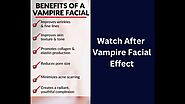 Vampire facial & Microneedling | Mohali | Chandigarh