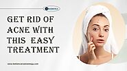 Get rid of acne with this easy treatment by Esthetica Cosmetology - Issuu