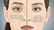 6.Blepharoplasty (Eyelid Surgery)