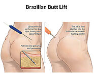 7.Brazilian Butt Lift