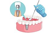 Say Goodbye to Gaps with Dental Implants in Riverside, CA