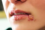Can syphilis on the lips be cured naturally? If so, what should be done?