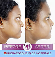 Advanced Jaw Surgery in India by Richardsons Hospital