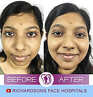 Enhance Your Profile with Expert Nose Surgery in India at Richardsons Hospital
