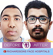 Enhance Your Profile with Genioplasty in India at Richardsons Hospital