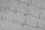 What is Normal ECG and Abnormal ECG?