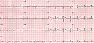 What is QRS Complex Abnormalities