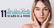11 Best Home Remedies To Reduce Acne Scars In a Week – Vince Beauty
