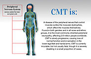Discover the Symptoms, Causes, and Treatment of Charcot-Marie-Tooth Disease