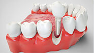 Dental Implants Aftercare: Dos and Don'ts