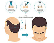 hair transplant in pune