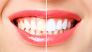 Five Dental Facts of Teeth Whitening You Should Know