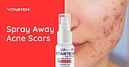 Tips to Spray Away Acne Scars: A Closer Look at Innovative Topical Antibiotics Like Vitastem - Stylebes